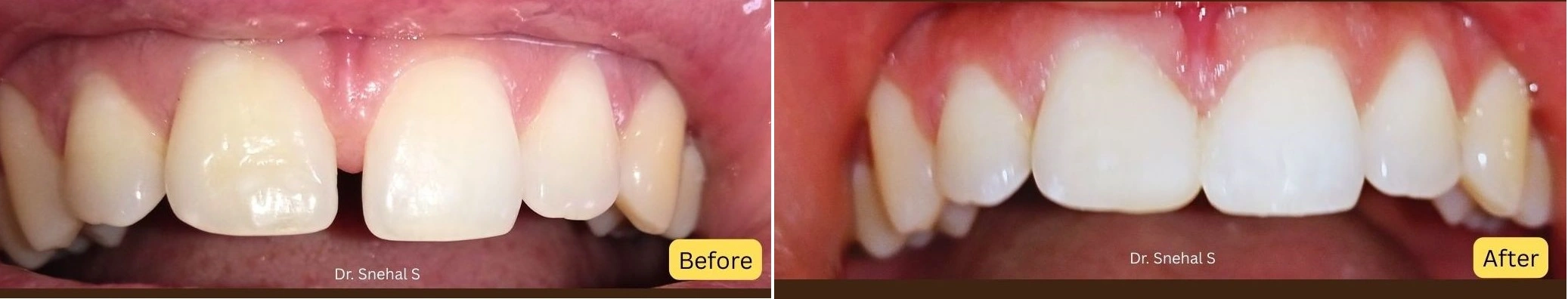 teeth cleaning